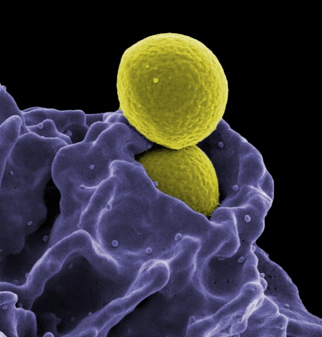 MRSA staph being ingested by a neutrophil.