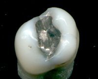 Amalgam filling