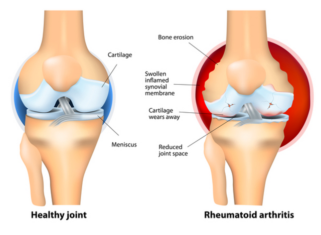 Rheumatoid Arthritis