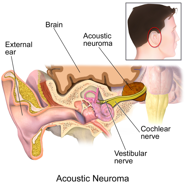 Acoustic neuroma