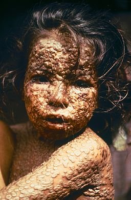 Child with Smallpox Bangladesh