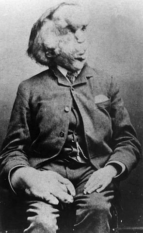 Joseph Merrick carte de visite photo, c. 1889.jpg