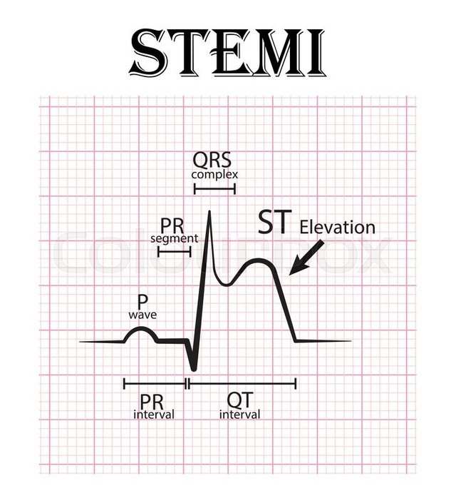 ST elevation MI