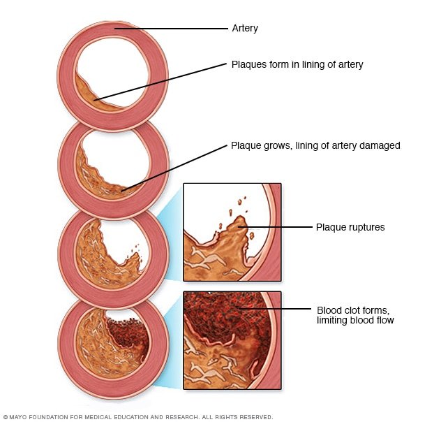 Atherosclerosis image from the above sited Mayo Clinic article.