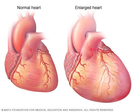 Illustration of an enlarged heart