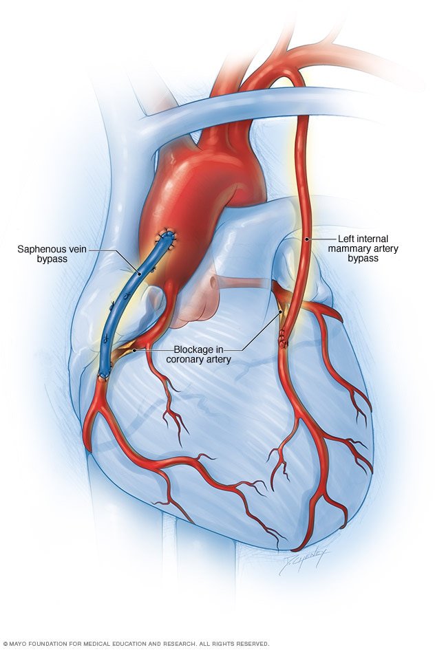 Bypass image from the above sited Mayo Clinic article.
