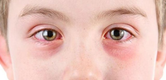 Allergic Conjunctivitis