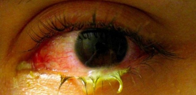 bacterial conjunctivitis