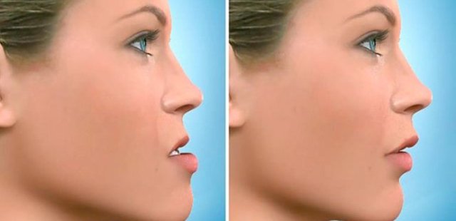 HOW CHIN REDUCTION SURGERY IS PERFORMED