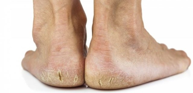 Causes and heel fissures