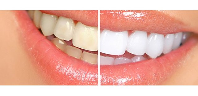 Herbal Teeth Whitening Methods