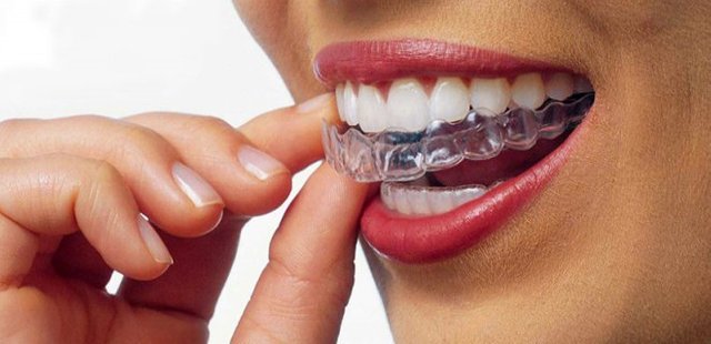 Invisalign