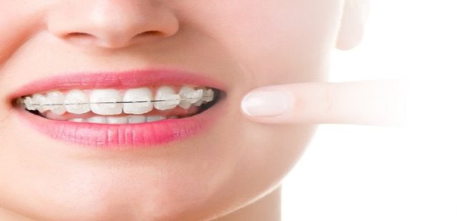 What Are The Types Of Braces