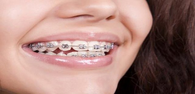 What Are The Types Of Braces