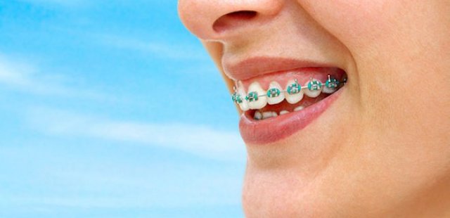 What Are The Types Of Braces