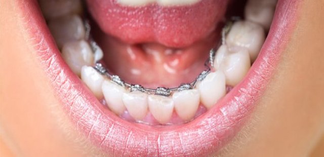 Lingual Braces