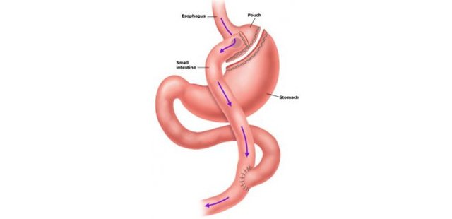 WHAT IS GASTRIC BYPASS