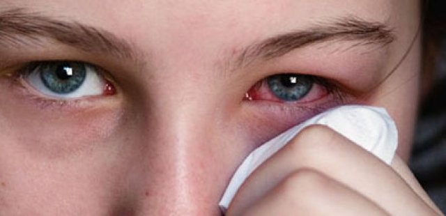 Adenoviral Conjunctivitis