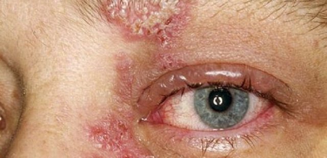 herpes simplex conjunctivitis and the keratit