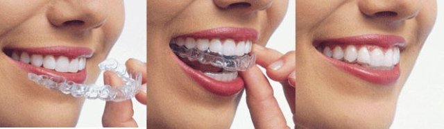 Treatment Invisalign