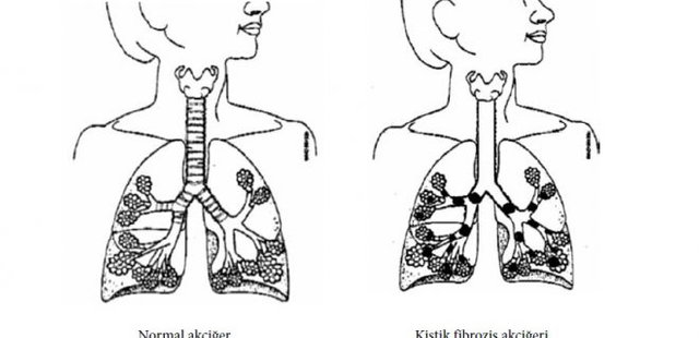 Symptoms Of Cystic Fibrosis