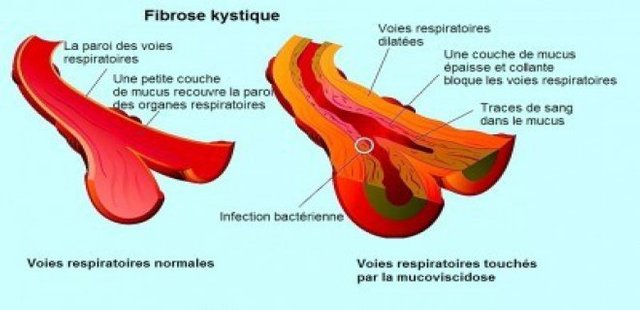 From The Disease Of Cystic Fibrosis Drugs