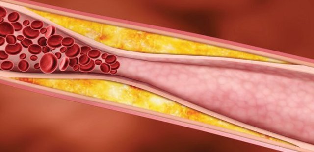 What Is Cholesterol