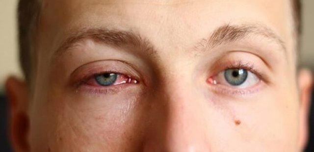 Conjunctivitis 