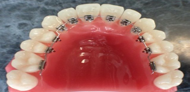 Lingual Braces