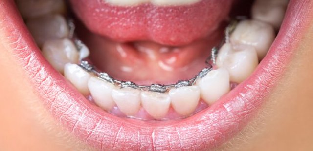 What Are Lingual Braces