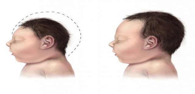 WHAT IS MICROCEPHALY