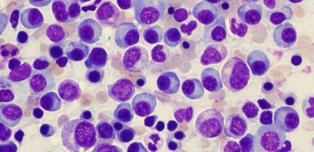 WHAT IS MULTIPLE MYELOMA
