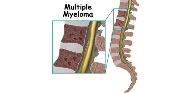 WHAT IS MULTIPLE MYELOMA