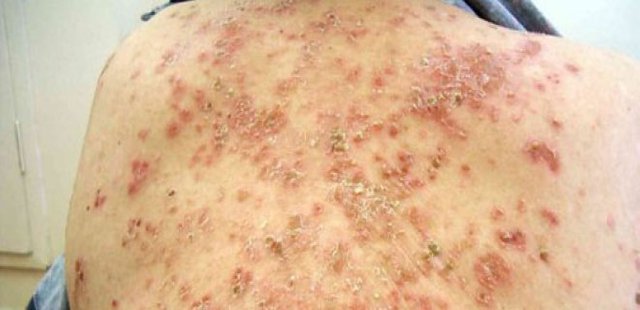 PEMPHIGUS DISEASE