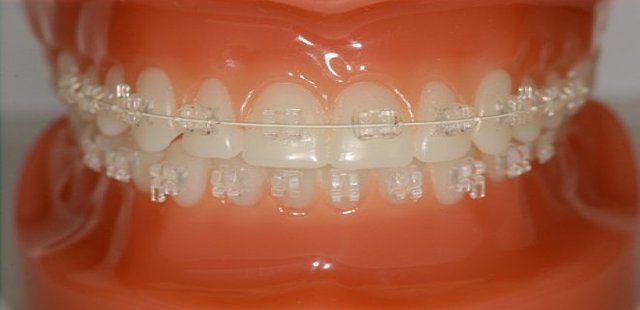 Porcelain Braces