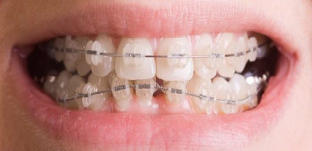 Porcelain Braces