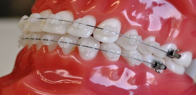 Porcelain Braces