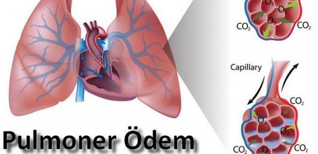 pulmoner-odem.jpg