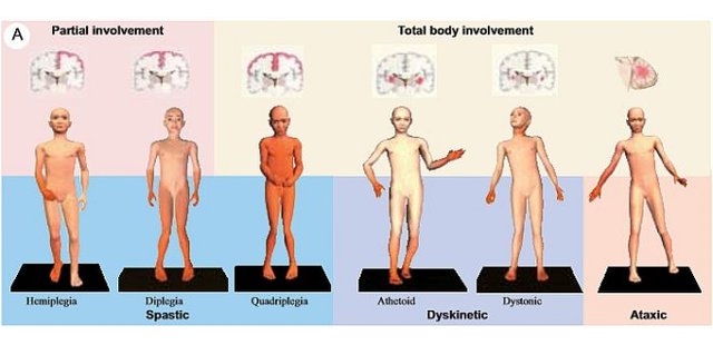 WHAT ARE THE TYPES OF CEREBRAL PALSY?