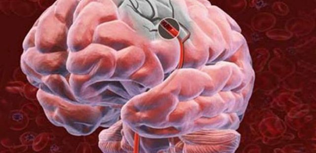 What Is Cerebrovascular Disease