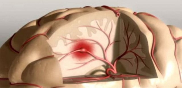 What Is Cerebrovascular Disease