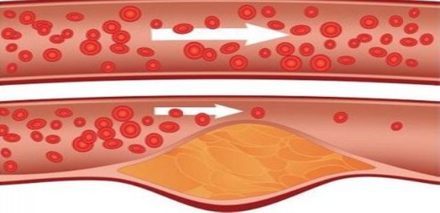 Cerebrovascular Disease Causes