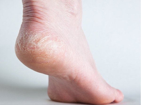 Causes and heel fissures