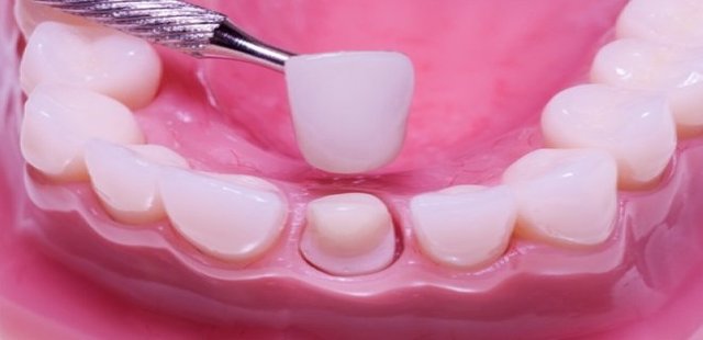 Dental Zirconium Is Used In Which Situations