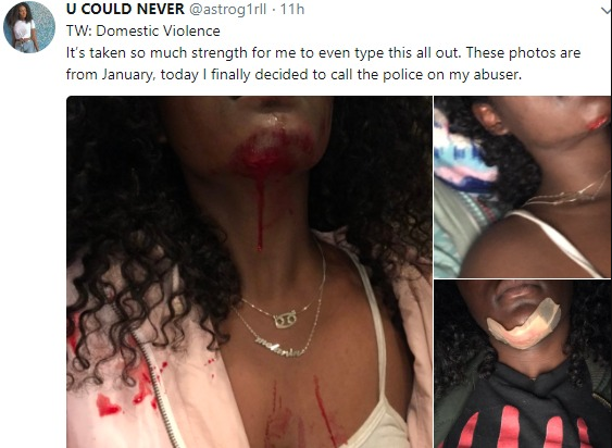 Domestic violence victim permanently scarred by her abuser shares her story and photos