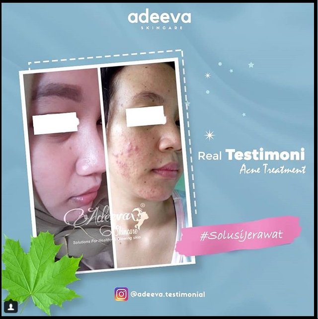 Testimoni Adeeva Acne Series terbaru