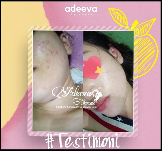 Testimoni asli Adeeva Acne Series terbaru terbaik