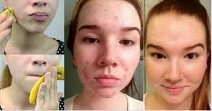 Featured image of post Banana Peel On Face Effects - I rubbed banana peel on my face for 1 week for pimples scars &amp; hyperpigmentation the results of using this banana peel mask was very impressive in my.