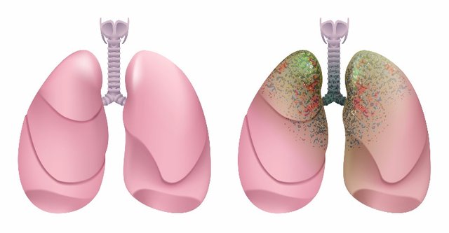 Healthyhumanlungs.Respiratorysystem.Lunglarynxandtracheaofhealthyperson.Respiratorysystemsmoker.Lungcancerb3819.jpg