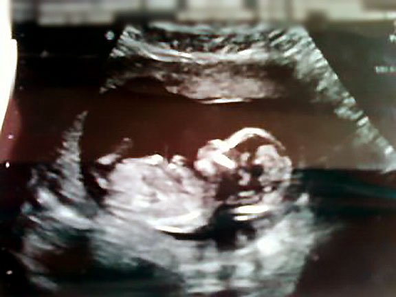 Estella's Ultrasound 13 weeks